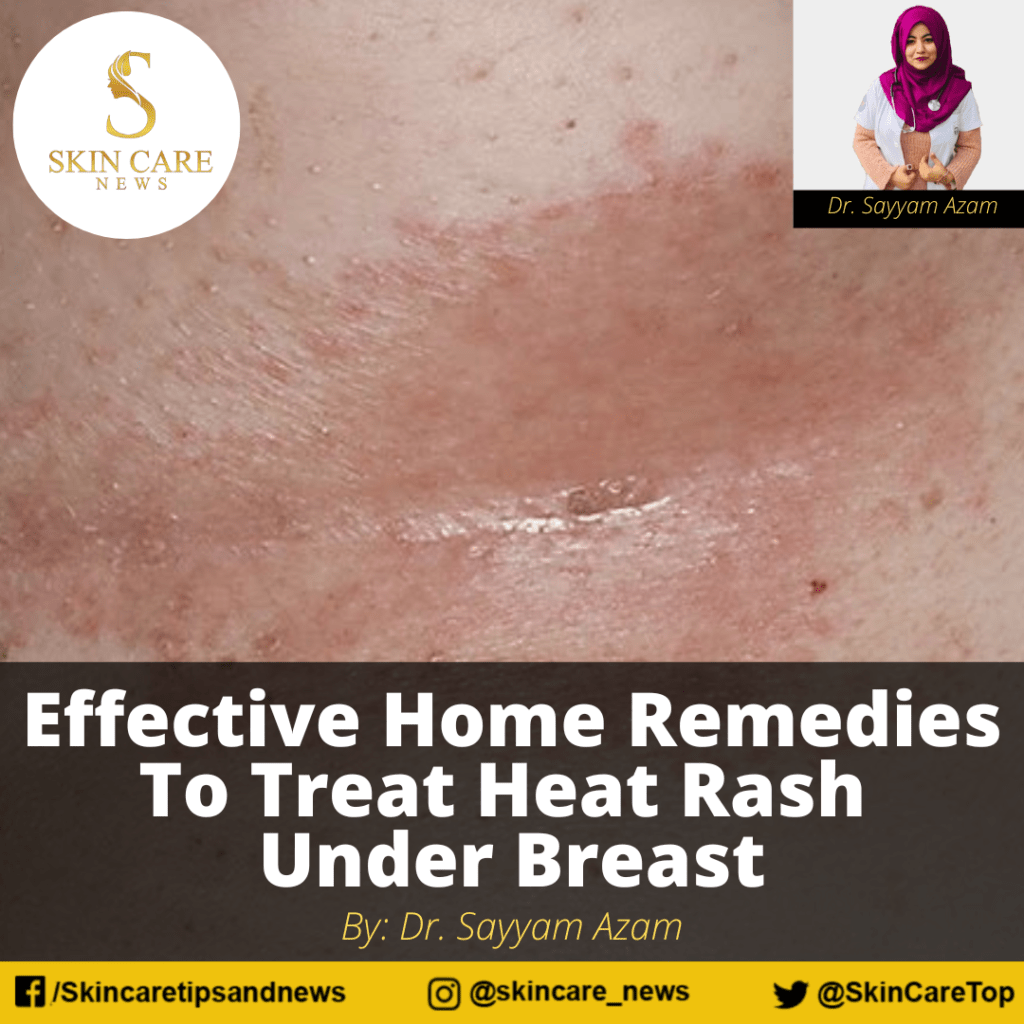 effective-home-remedies-to-treat-heat-rash-under-breast