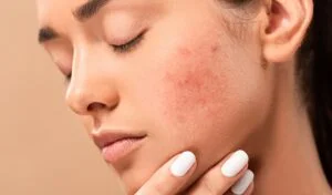 Argan Yağının Yüzünüze Uygulanması Cilt Hücrelerinizin Sebum Üretimini Nasıl Kontrol Edebilir?