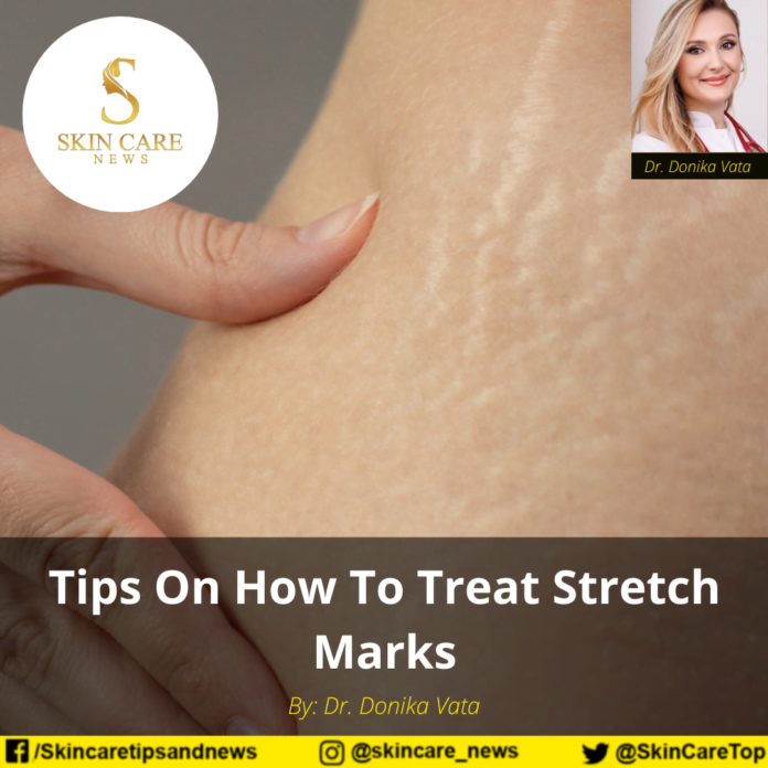 Tips On How To Treat Stretch Marks