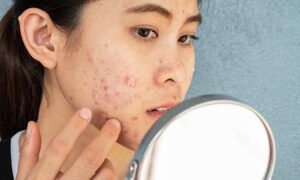 Deeper Than Just The Skin: Is Your Skin Affecting Your Mental Health?