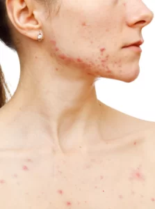 Cystic Acne: A Curse To The Skin