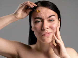 Do's And Don'ts If You Are Suffering From Blackheads