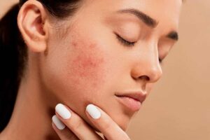 Effectiveness Of Vitamin C For Acne And Acne Scars
