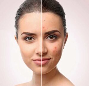 Effectiveness Of Vitamin C For Acne And Acne Scars