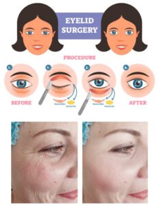Eyelid Surgery – The Most Common Cosmetic Procedure