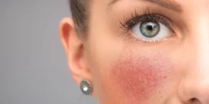 How To Reduce Redness On Your Face 