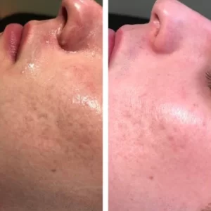 Micro Needling - A Top Treatment For Open Pores