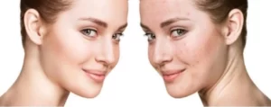 Skin Benefits Of Intermittent Fasting