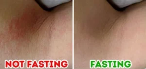 Skin Benefits Of Intermittent Fasting