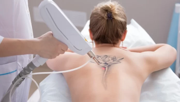 What Should You Know About Tattoo Removal