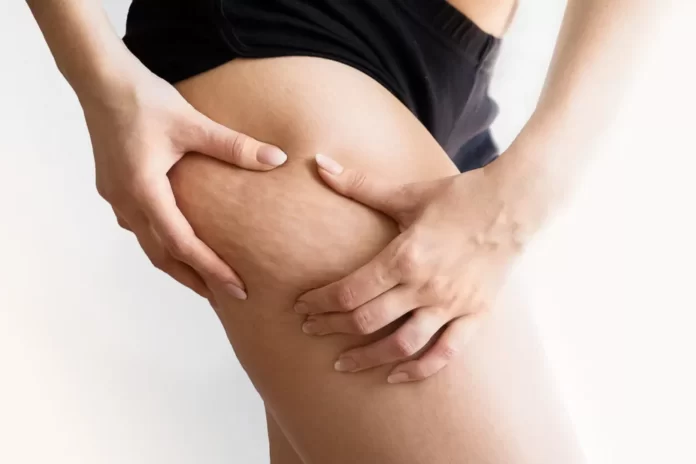 Caffeine And Its Ability to Reduce Cellulite