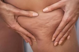 Caffeine And Its Ability to Reduce Cellulite