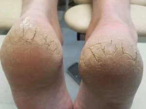 Cracked Heels: The Reasons And Possible Solutions