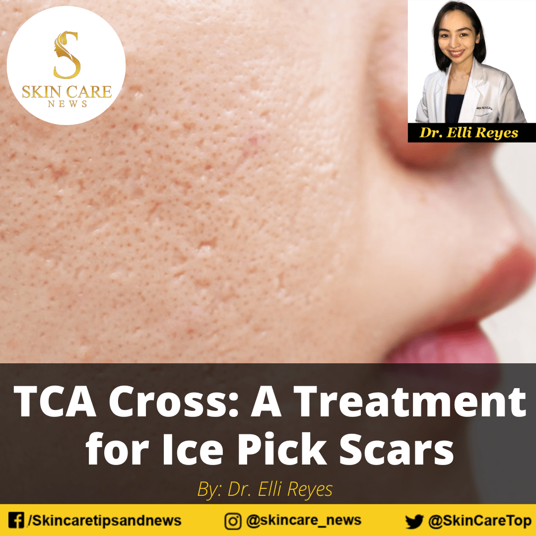 TCA Cross: A Treatment for Ice Pick Scars