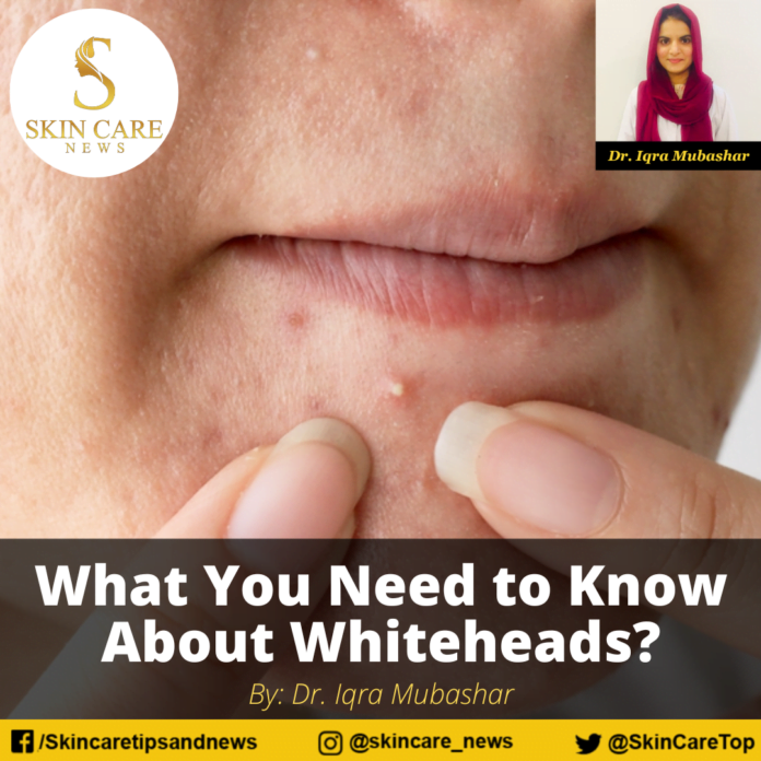 What You Need to Know About Whiteheads?