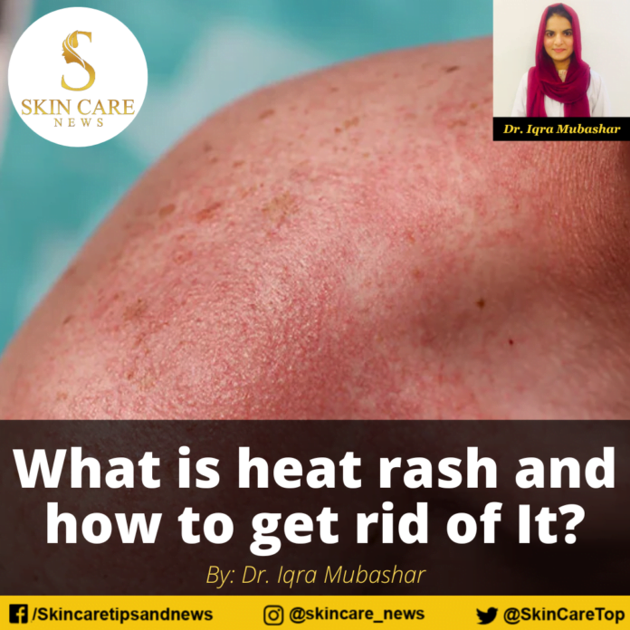 What is heat rash and how to get rid of It?