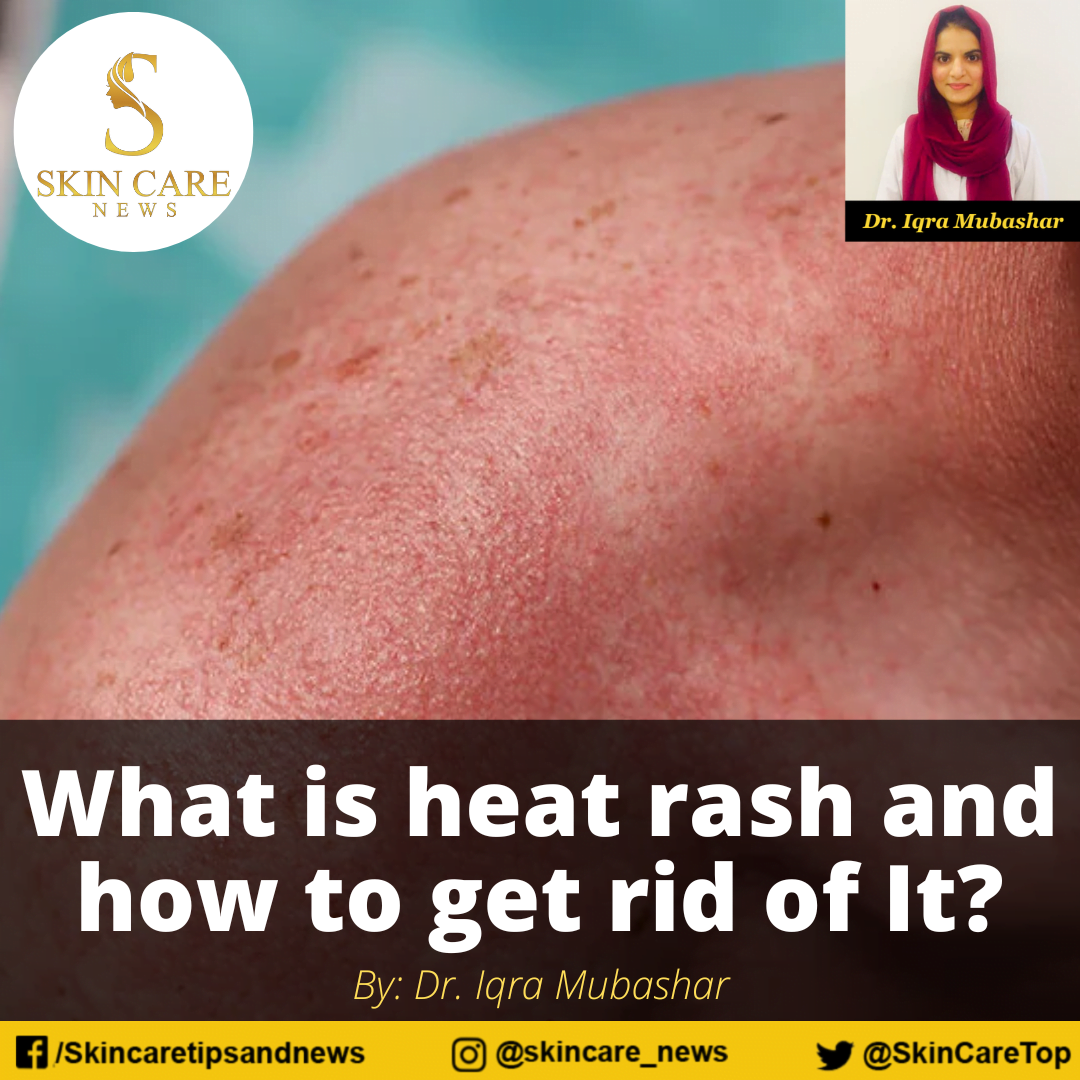 what-is-heat-rash-and-how-to-get-rid-of-it