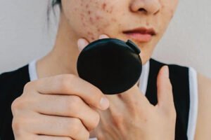 How Is Stress Related to Acne? 