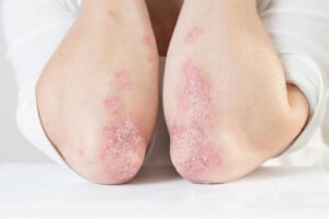 Effectiveness Of Vitamin D For Psoriasis 