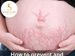 How to prevent and eliminate stretch marks during pregnancy?