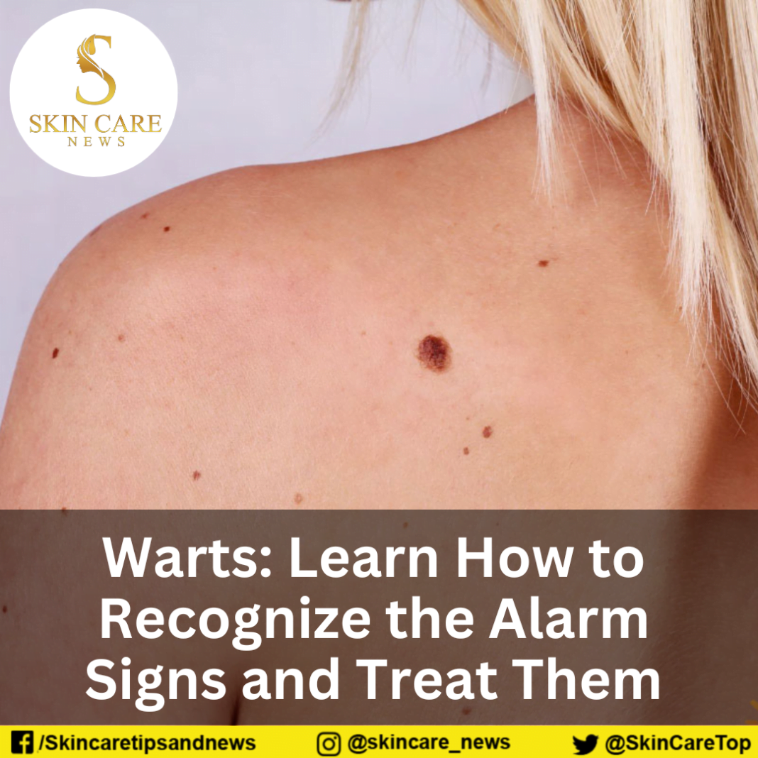 Warts Learn How to Recognize the Alarm Signs and Treat Them