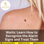 Warts: Learn How to Recognize the Alarm Signs and Treat Them Warts: Learn How to Recognize the Alarm Signs and Treat Them