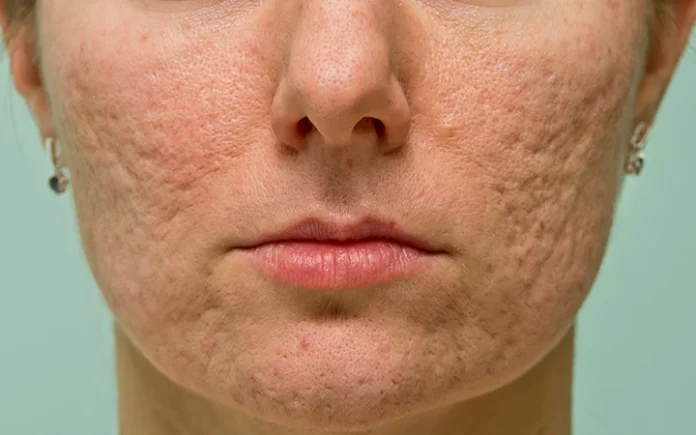 Lighten Up: 5 Best Ways to Treat Post Acne Hyperpigmentation