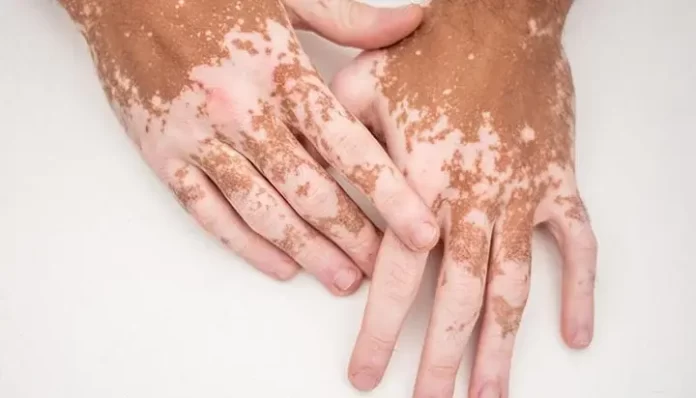 Understanding Vitiligo in Children: Early Symptoms and Causes