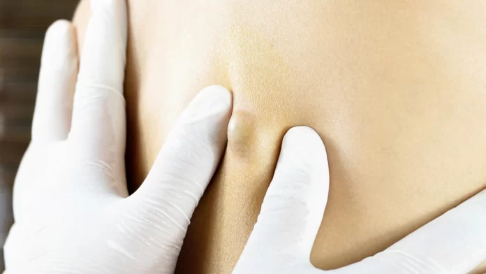 Dermoid Cyst: Understanding a Unique Skin Condition