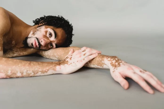 Embracing Uniqueness: Understanding Vitiligo and the Beauty of Diversity