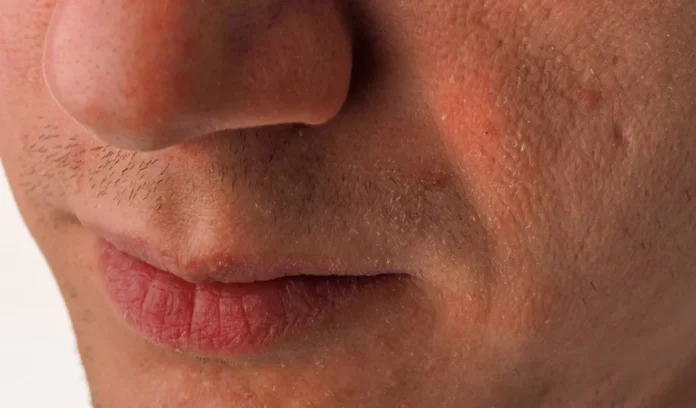 Battling Dry Skin in Men: Tips for a Healthy and Hydrated Complexion