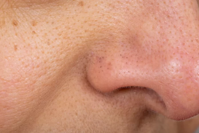Banishing Stubborn Blackheads: A Dermatologist's Comprehensive Guide