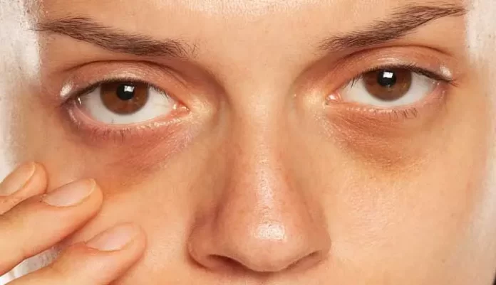 A Dermatologist's Guide on How to Effectively Remove Dark Circles Under Eyes