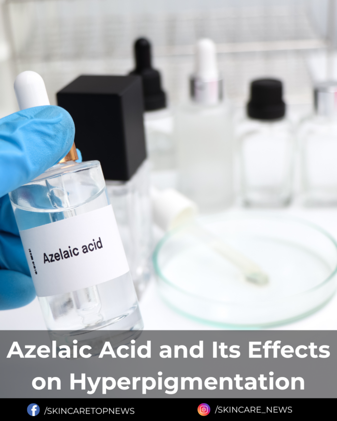 Azelaic Acid and Its Effects on Hyperpigmentation